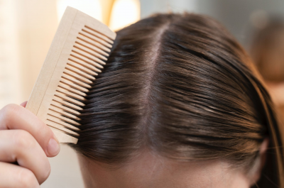 Inilah Penyebab Timbulnya Dermatitis Seboroik!